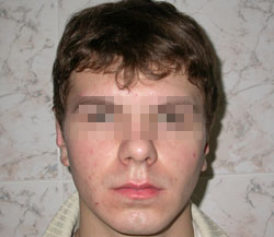 оттопластика, доктор Абовян